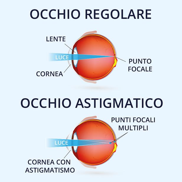 Diagramma di un bulbo oculare con e senza astigmatismo