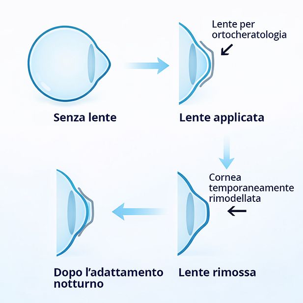 Diagramma della forma del bulbo oculare prima, durante e dopo l'uso di una lente Ortho-k